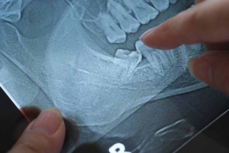 Tooth Extraction in Gulf Shores